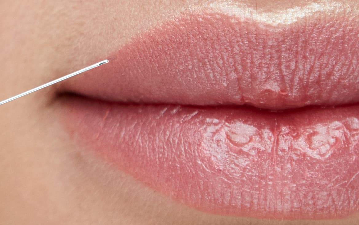 Microcânula fill·k posicionada na comissura labial, entrando por um único ponto de entrada